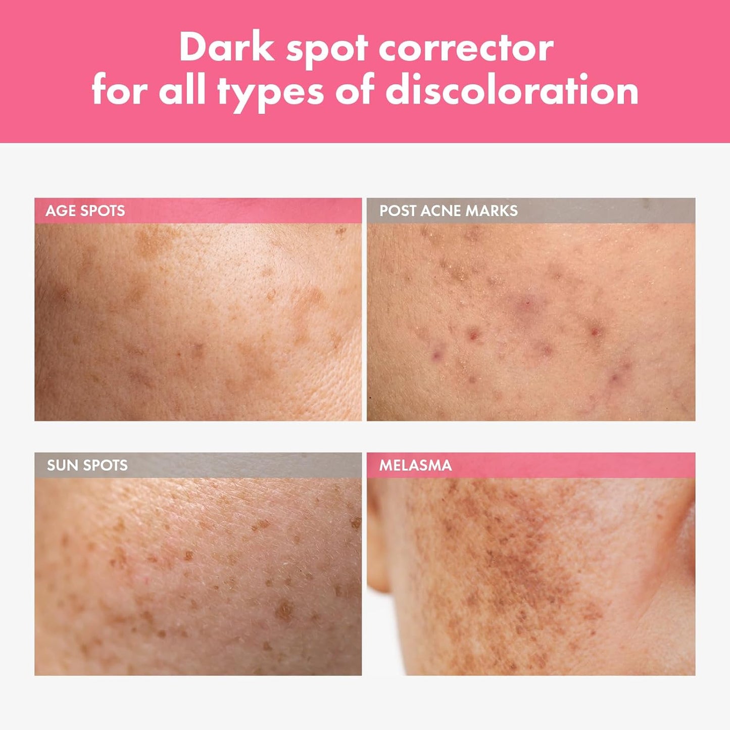 Arbutin 7% + Tranexamic Acid 4% Cream